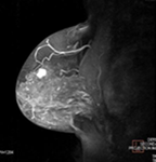 MRI画像 乳房のイメージ