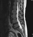 MRI画像 脊椎のイメージ