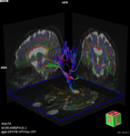 MRI画像 神経のイメージ