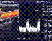 頸動脈超音波画像