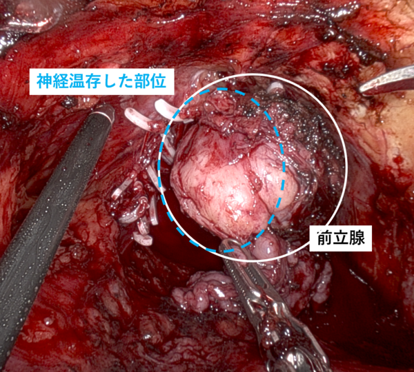 前立腺図添付