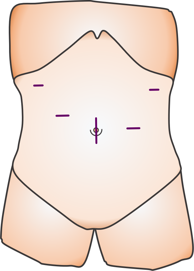 腹腔鏡手術のイメージ6