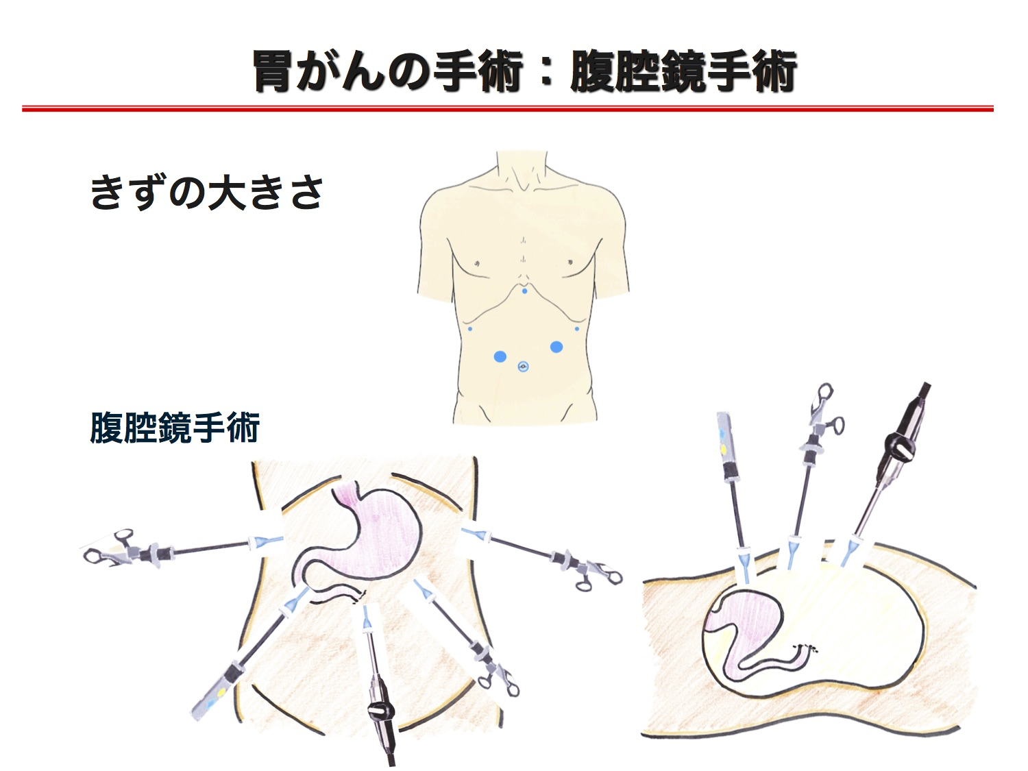 胃がんの手術の図