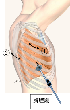 胸腔鏡併用手術の図