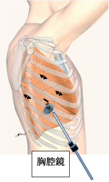 胸腔鏡下手術の図