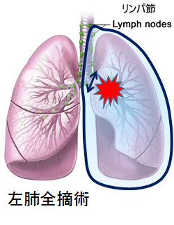 片肺全摘術の図