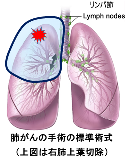 肺葉切除術の図