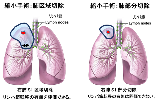 肺域切除、肺部区分切除の図