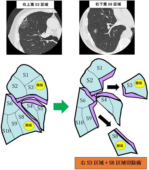 肺区域切除術の図