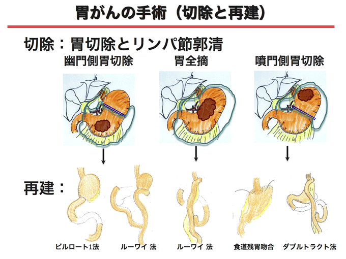 胃がんの手術の図