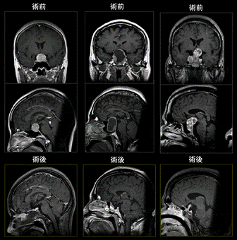 図4.下垂体腺腫における術前および術後MRI画像(1)