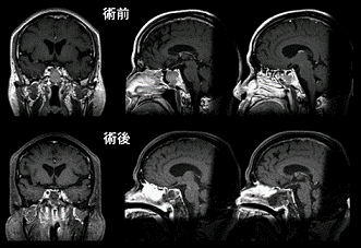 図5.下垂体腺腫における術前および術後MRI画像(2)