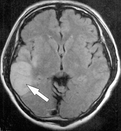 図1:MRI-脳梗塞
