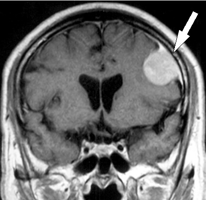 図4:MRI-髄膜腫