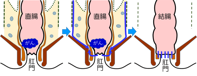 肛門に近い直腸がんに対する肛門温存手術（ISR）の図
