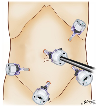 腹腔鏡手術のイメージ1