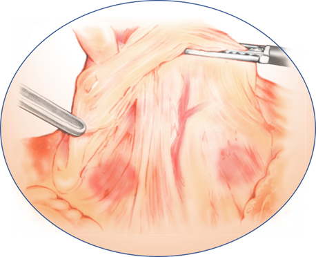 腹腔鏡手術のイメージ2