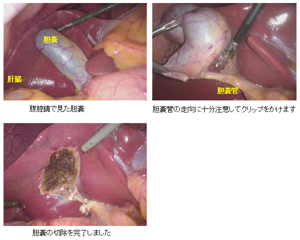 腹腔鏡下胆嚢摘出術のイメージ1