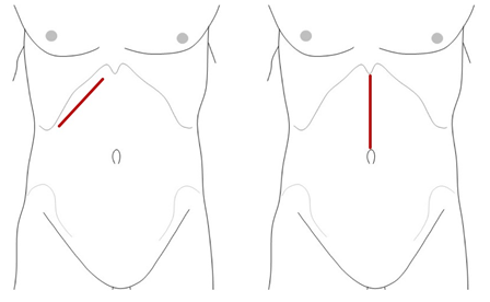 腹腔鏡下胆嚢摘出術のイメージ3