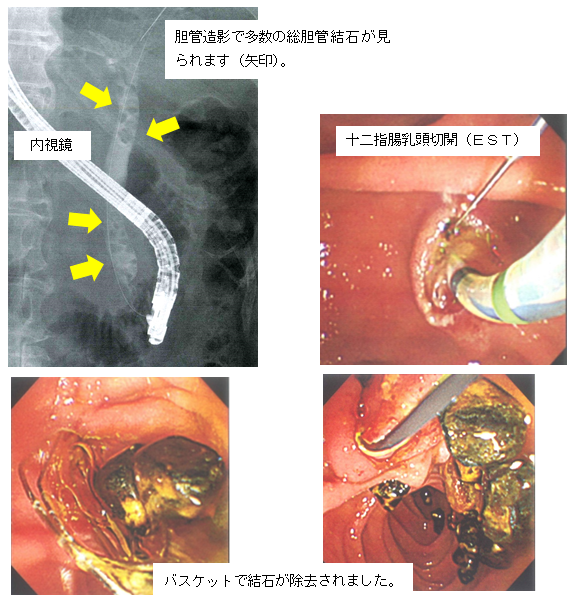 ERCP 内視鏡的逆行性胆道膵管造影のイメージ
