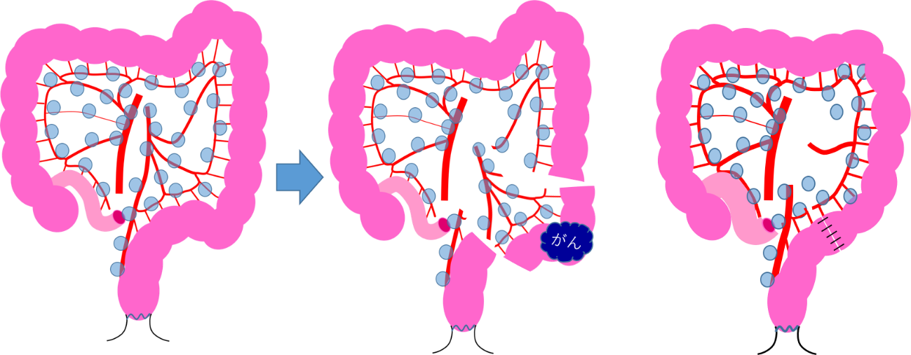 S状結腸がんに対する手術の図