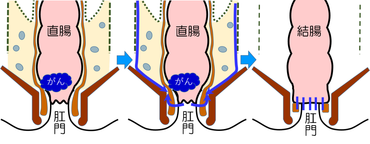 S状結腸がんに対する手術の図