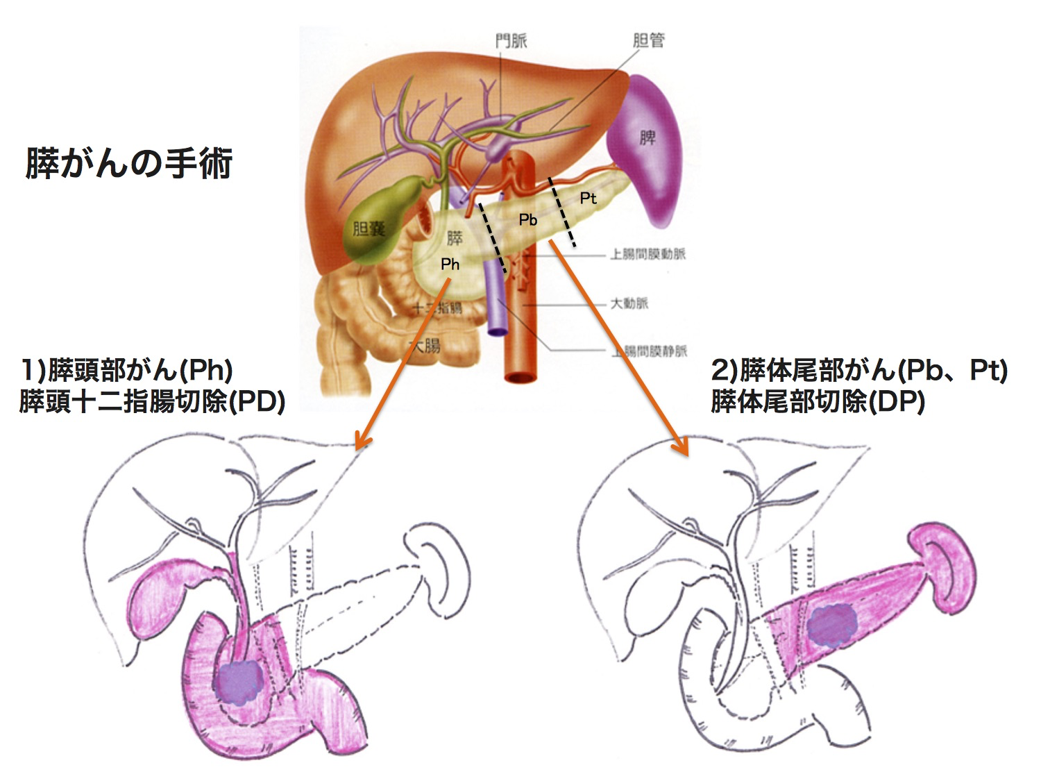 膵臓がんの手術の図