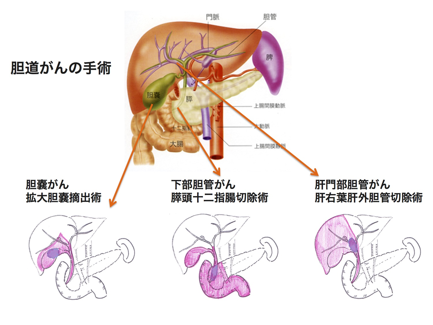 胆道がんの手術の図