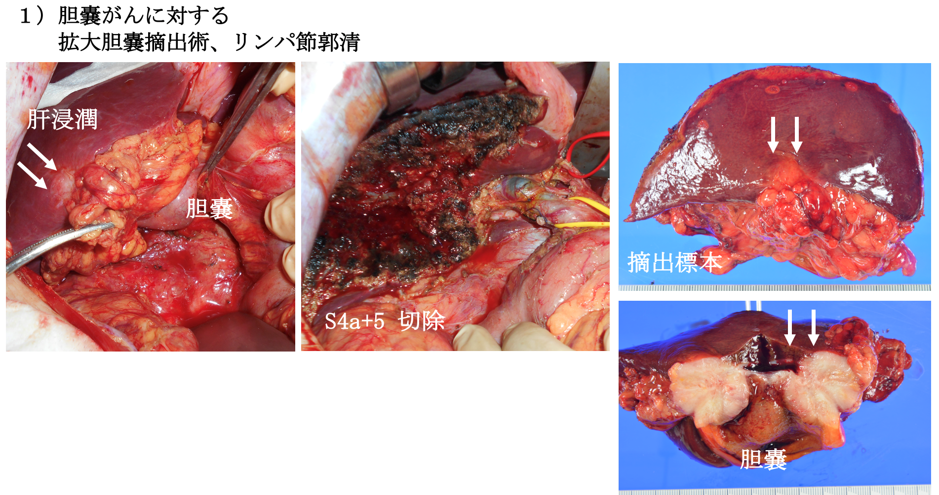 胆道がんの手術の図